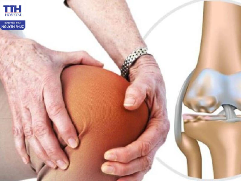 Nên xây dựng phác đồ điều trị toàn diện cho bệnh nhân thoái hóa khớp gối