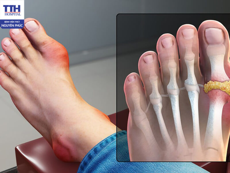 Bệnh gout là gì?