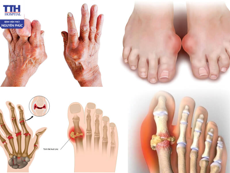 Các dạng bệnh gout thường gặp và nên biết để phòng tránh