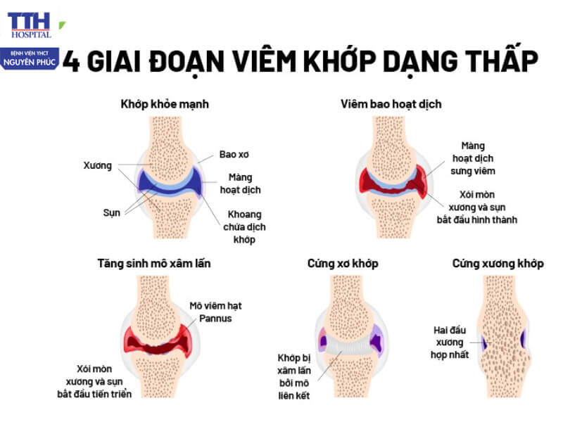 Các giai đoạn của viêm khớp dạng thấp tiến triển âm thầm và dễ nhầm lẫn với các bệnh khác