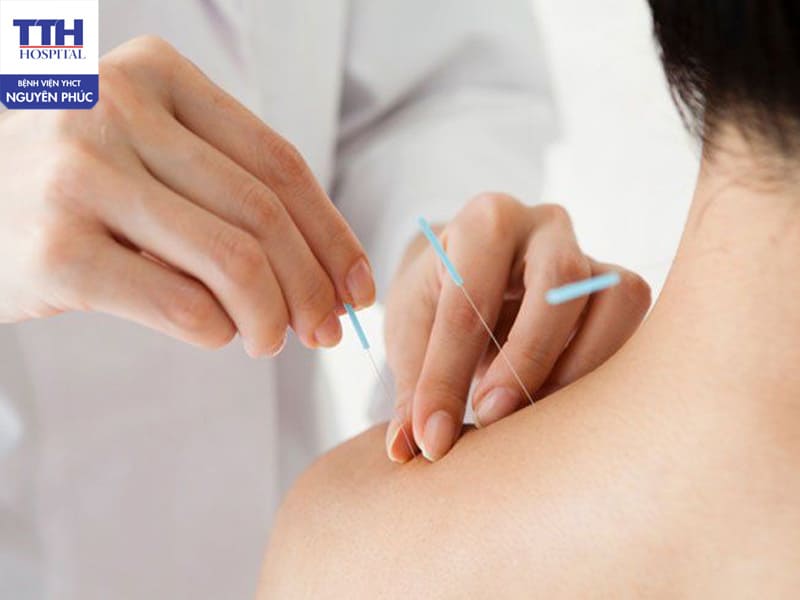 Châm cứu điều trị đau cổ vai gáy 