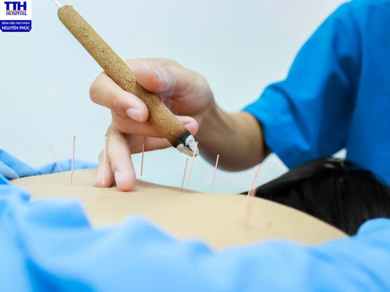 Châm cứu trị liệu