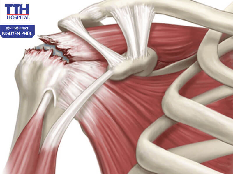 Chóp xoay vai là gì? Vì sao dễ bị tổn thương?