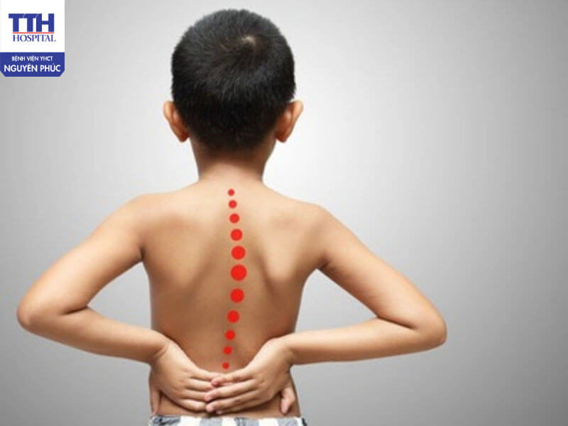 Cong vẹo cột sống ở trẻ là gì?