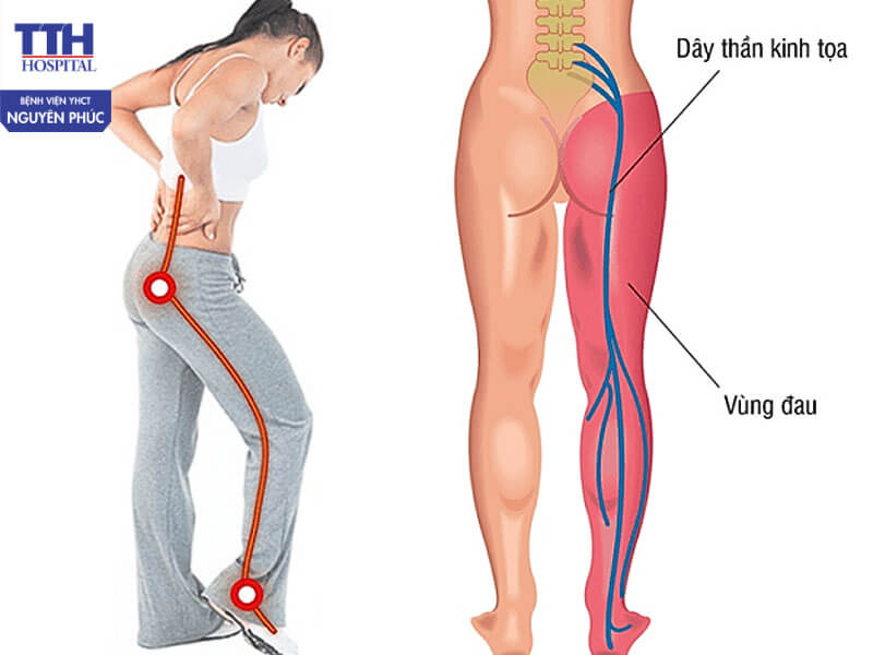 Đau dây thần kinh tọa là gì?