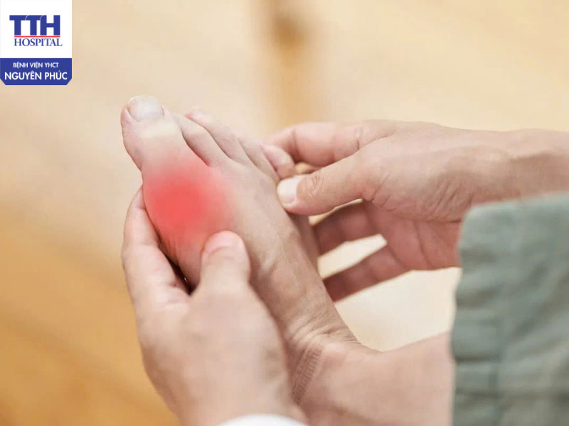 Dấu hiệu cơn Gout cấp không nên bỏ qua