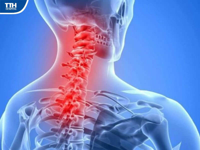 Đau vai gáy do thoái hóa cột sống cổ