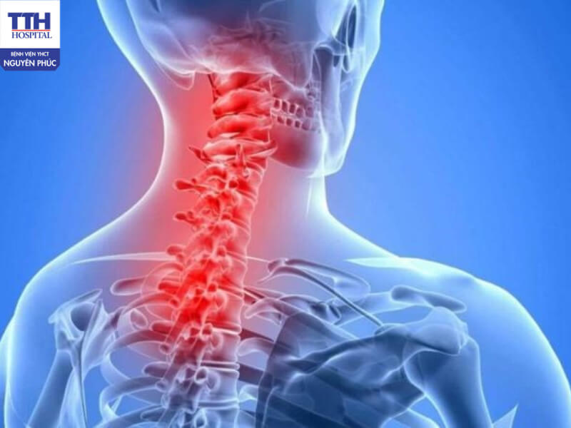 Đau vai gáy là biểu hiện của sự rối loạn chức năng cơ – xương – khớp ở vùng cổ, vai và gáy