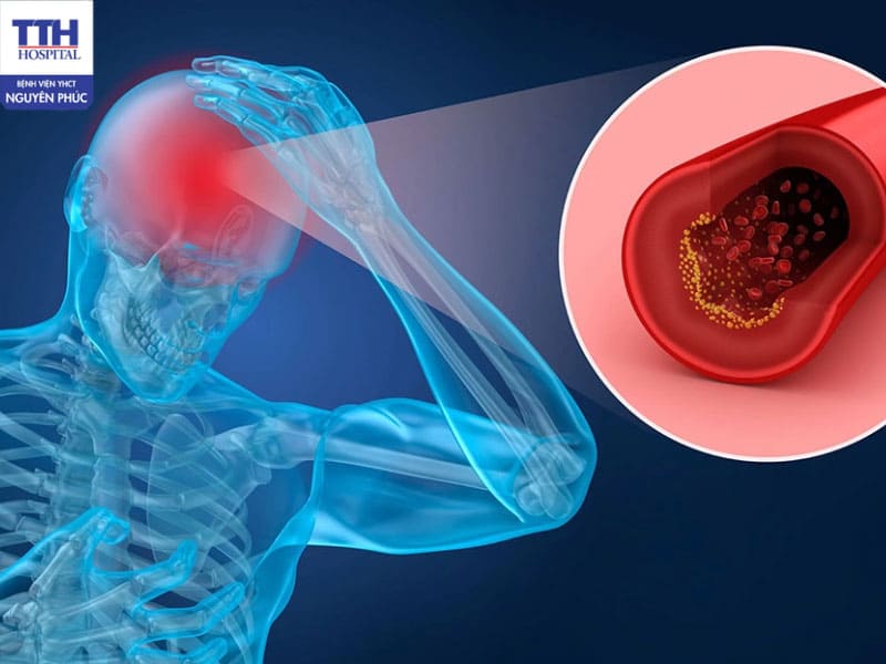 Điều trị bằng oxy cao áp có cải thiện rõ rệt về khả năng vận động, ngôn ngữ và trí nhớ