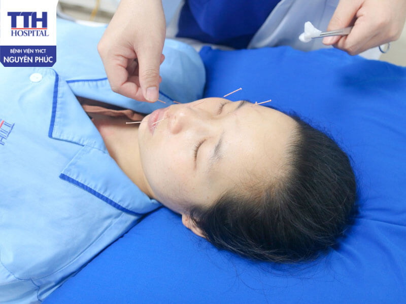 Điều trị liệt dây thần kinh số VII bằng Y học cổ truyền tại Bệnh viện YHCT Nguyên Phúc