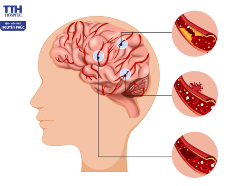 Đột quỵ có rất nhiều nguyên nhân gây ra nên chủ động tìm hiểu để tránh biến chứng