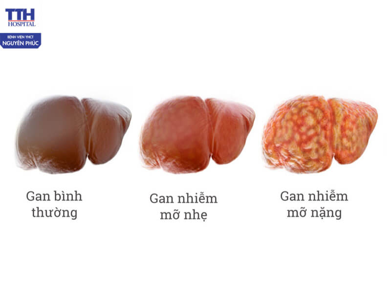 Các giai đoạn của gan nhiễm mỡ cần biết