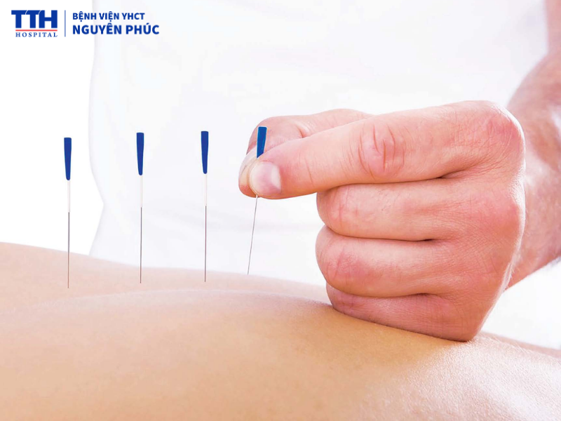 Hào châm là gì? Phương pháp này có ưu điểm gì?