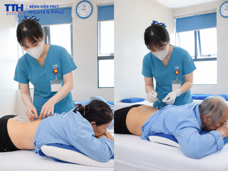 Hào châm và cấy chỉ: Phương pháp nào phù hợp hơn?