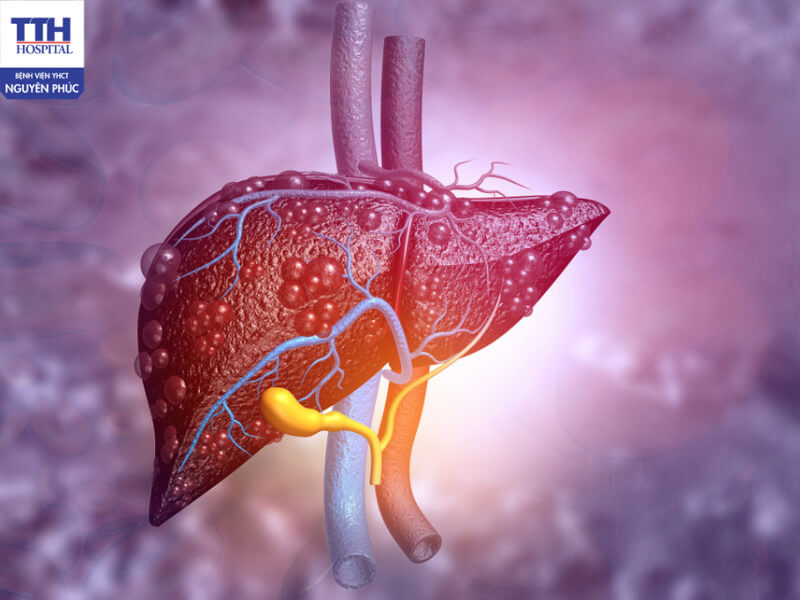 Hình ảnh mô phỏng gan nhiễm mỡ