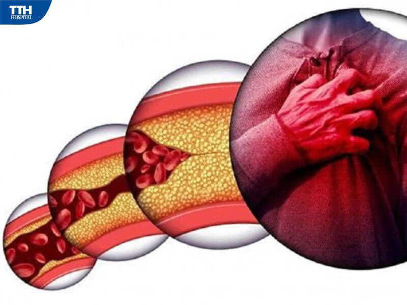 Nguyên nhân rối loạn mỡ máu ở người cao tuổi