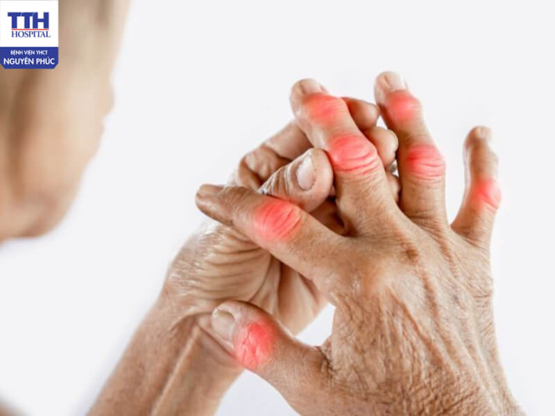 Nguyên nhân chính xác của viêm khớp dạng thấp vẫn chưa được xác định rõ