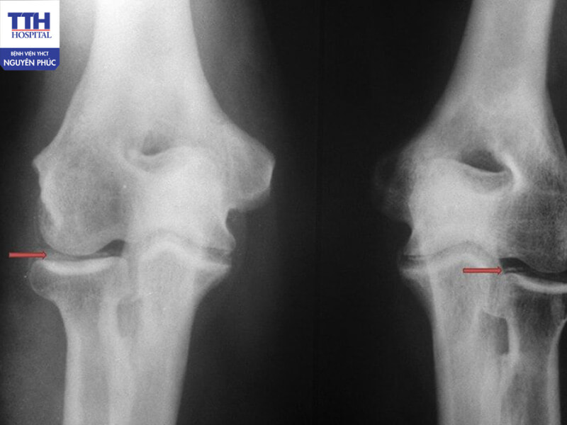 Oxy cao áp mang nhiều lợi ích trong hỗ trợ điều trị thoái hóa khớp
