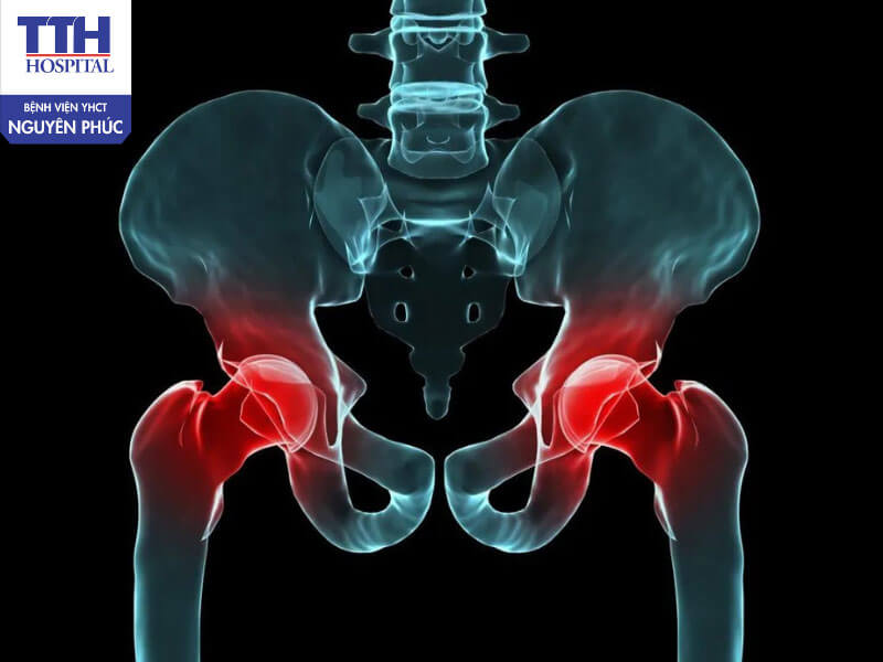 Phẫu thuật thay khớp háng nhân tạo là gì?