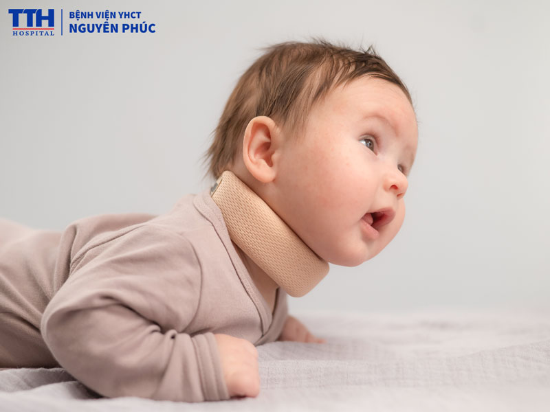 Phục hồi chức năng - Giải pháp quan trọng trong điều trị vẹo cổ ở trẻ