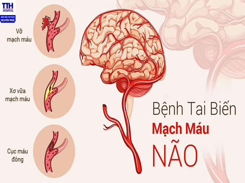 Quan điểm YHCT về tai biến mạch máu não
