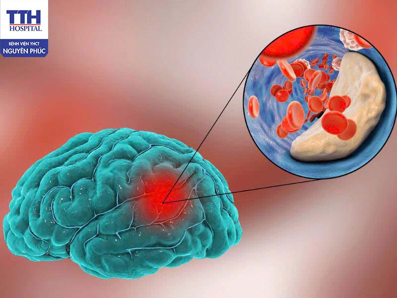 Khi não thực sự thiếu oxy - tình trạng nguy hiểm cần lưu ý