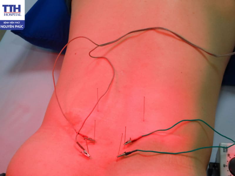 Tại bệnh viện YHCT Nguyên Phúc điều trị thoát vị đĩa đệm chuyên sâu giúp giảm đau, phục hồi nhanh