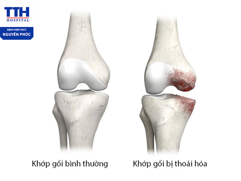 Thoái hóa khớp là gì?