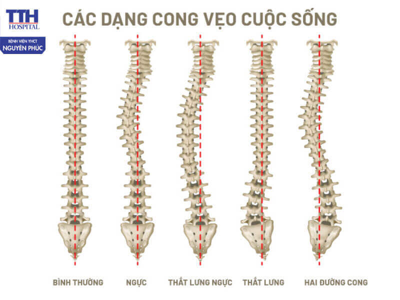 Tổng quan về cong vẹo cột sống