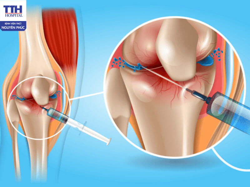 Tiêm chất nhờn dịch khớp là kỹ thuật đưa trực tiếp dung dịch có tính nhờn vào khoang khớp gối