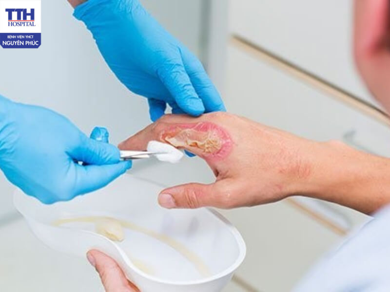 Ứng dụng oxy cao áp trong hỗ trợ điều trị bỏng giúp cải thiện và làm mềm vùng tổn thương