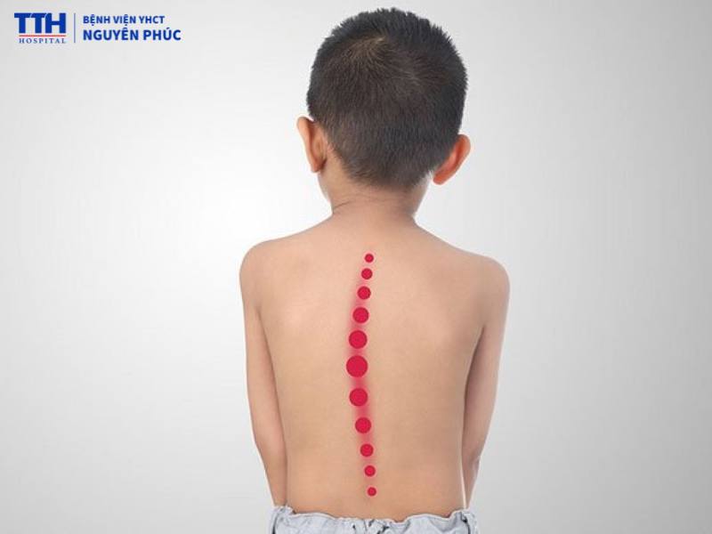 Vẹo cột sống ở trẻ là gì?
