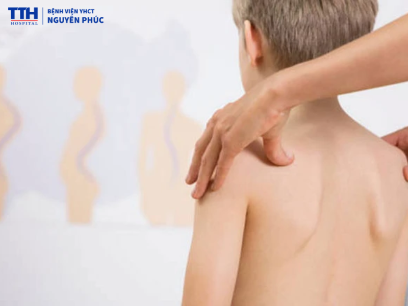 Vì sao cần phát hiện sớm vẹo cột sống ở trẻ?