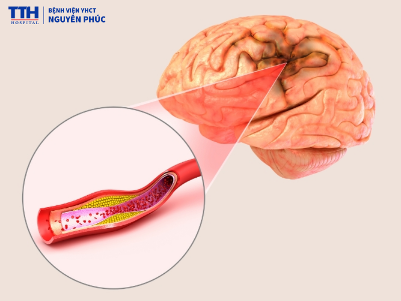 Vì sao cần phục hồi chức năng sớm sau tai biến mạch máu não?