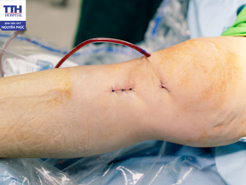 Việc phục hồi sau phẫu thuật tái tạo dây chằng chéo trước rất quan trọng và cần thiết cho hậu phẫu.