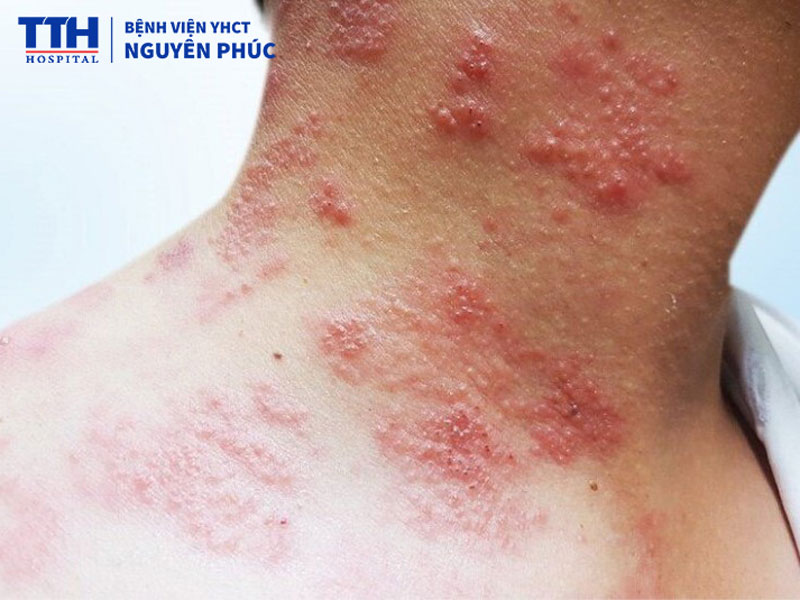 Zona thần kinh là gì?