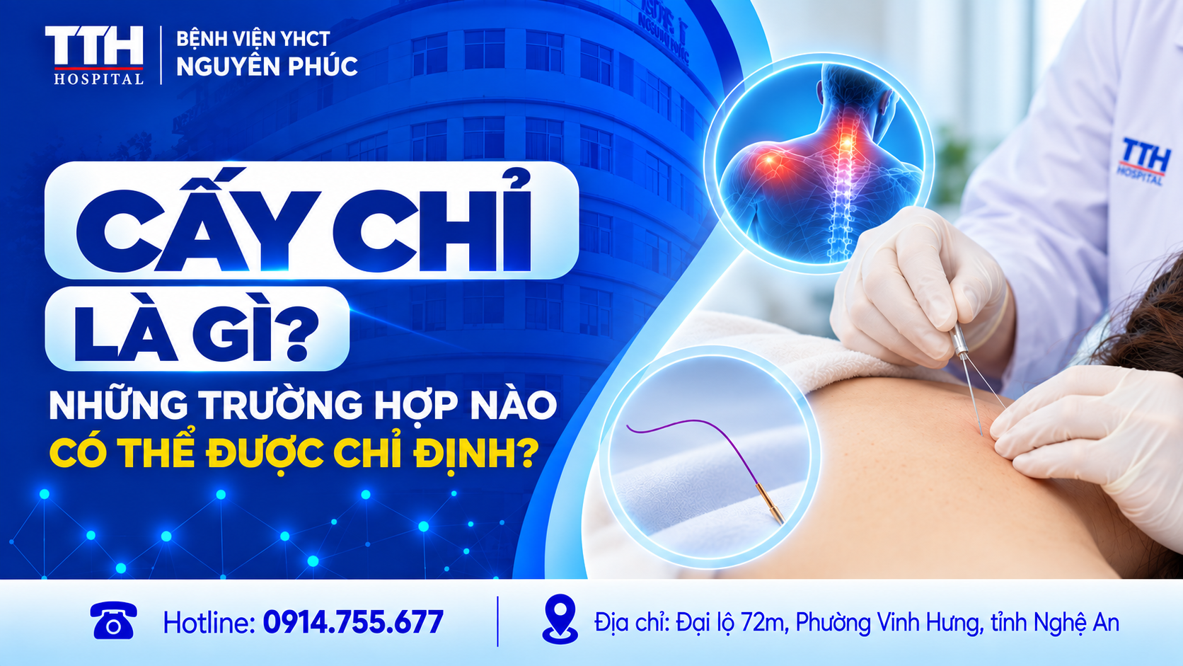 CẤY CHỈ LÀ GÌ? NHỮNG TRƯỜNG HỢP NÀO CÓ THỂ ĐƯỢC CHỈ ĐỊNH?