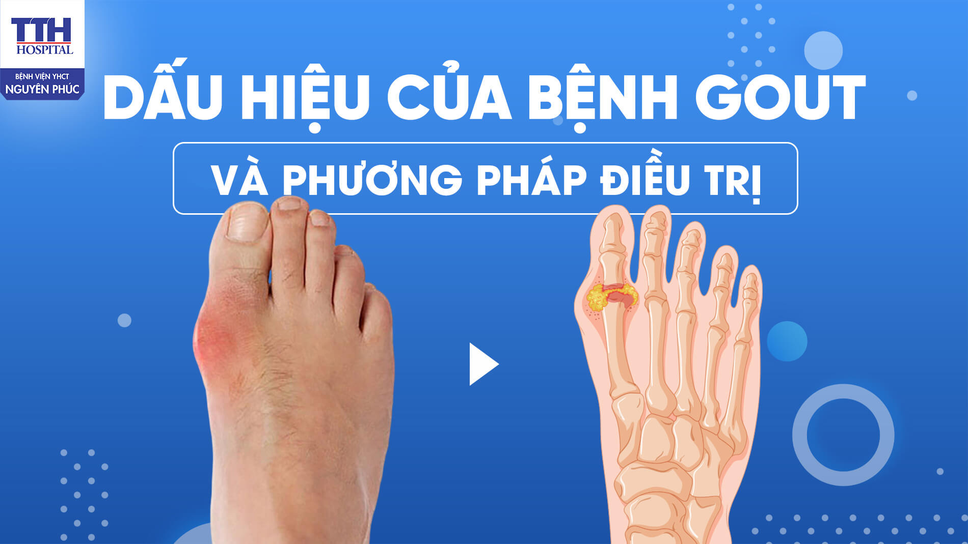 Dấu hiệu của bệnh Gout và phương pháp điều trị