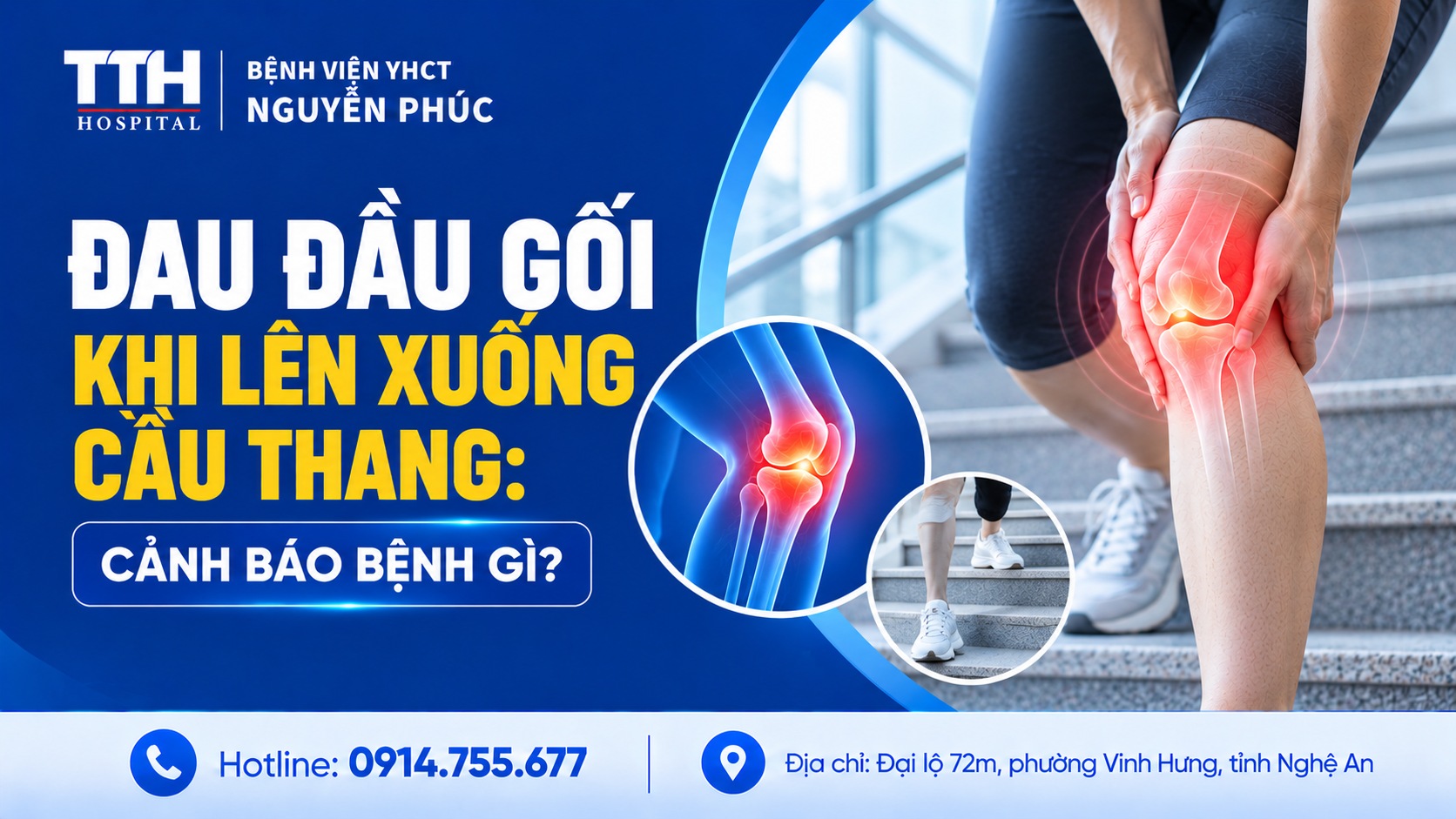 ĐAU ĐẦU GỐI KHI LÊN XUỐNG CẦU THANG: CẢNH BÁO BỆNH GÌ?
