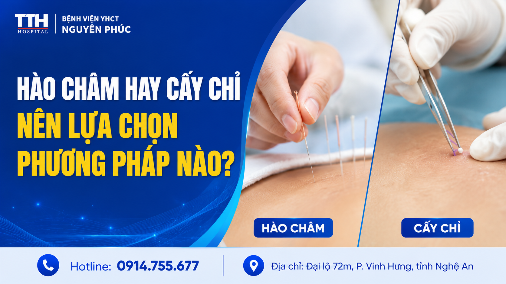 HÀO CHÂM HAY CẤY CHỈ – NÊN LỰA CHỌN PHƯƠNG PHÁP NÀO?