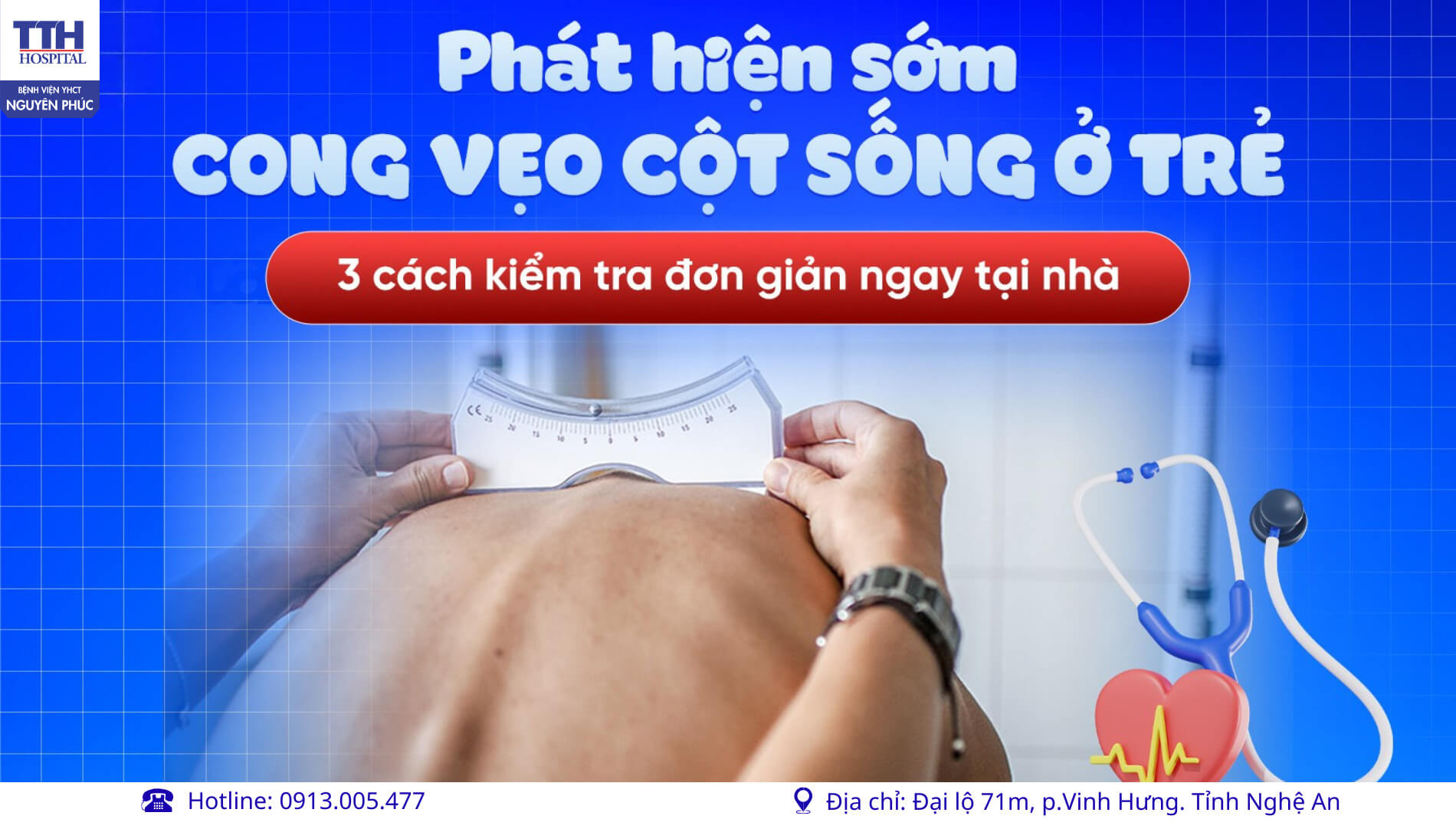PHÁT HIỆN SỚM CONG VẸO CỘT SỐNG Ở TRẺ