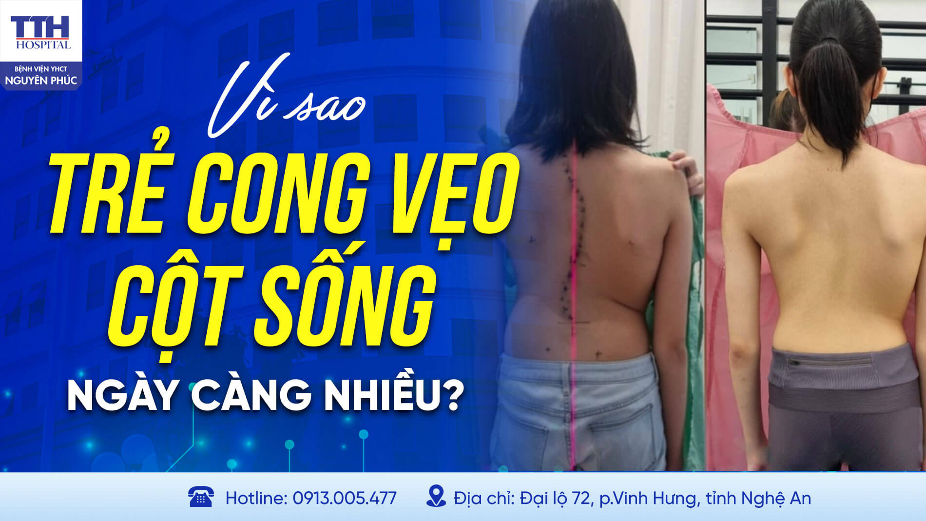 VÌ SAO TRẺ BỊ CONG VẸO CỘT SỐNG NGÀY CÀNG NHIỀU?